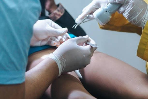 circoncision